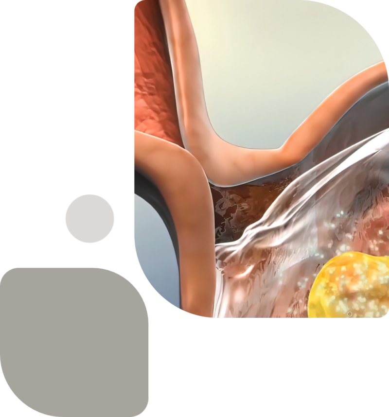 Achalasia - Tampa Bay Reflux Institute