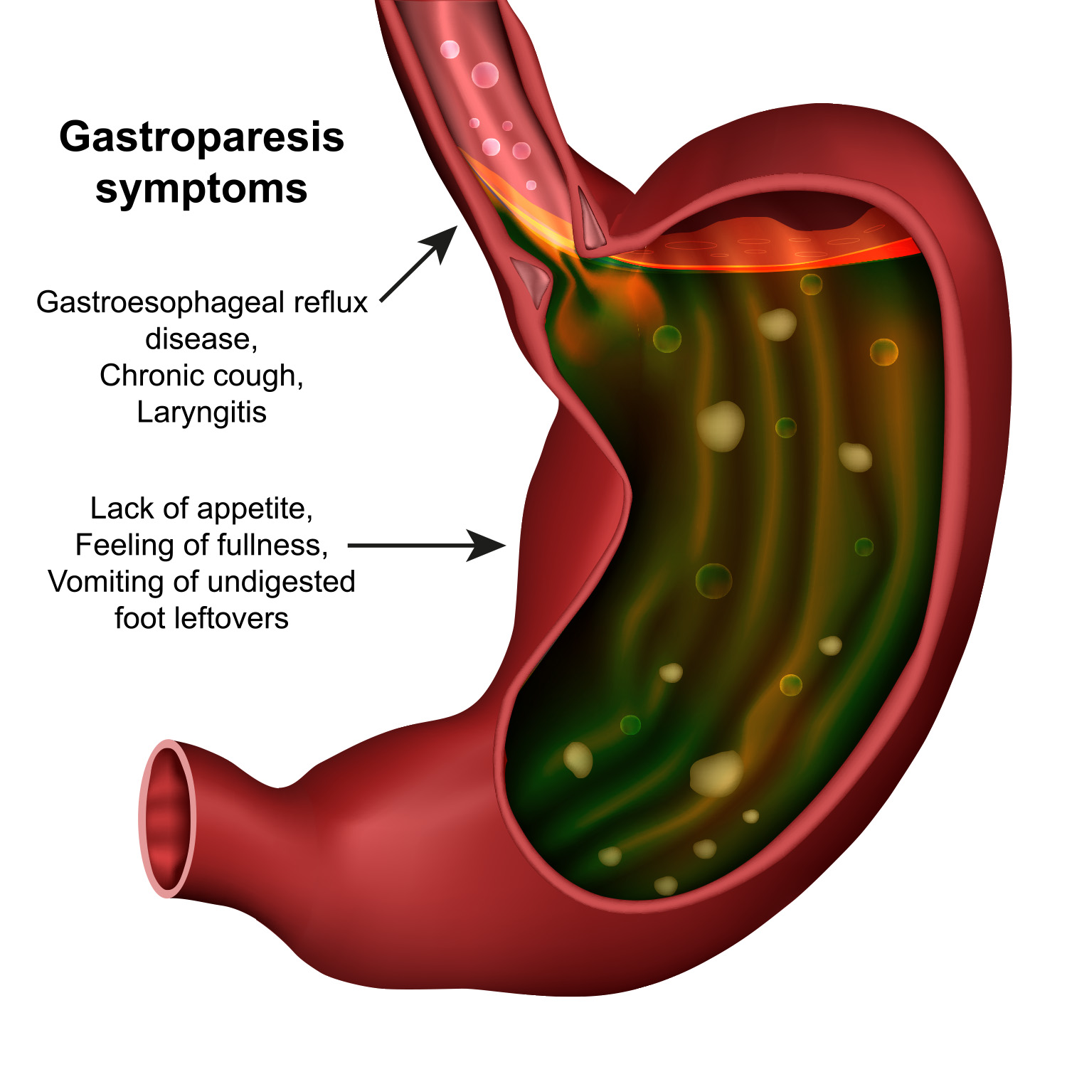 gastroparesis symptoms