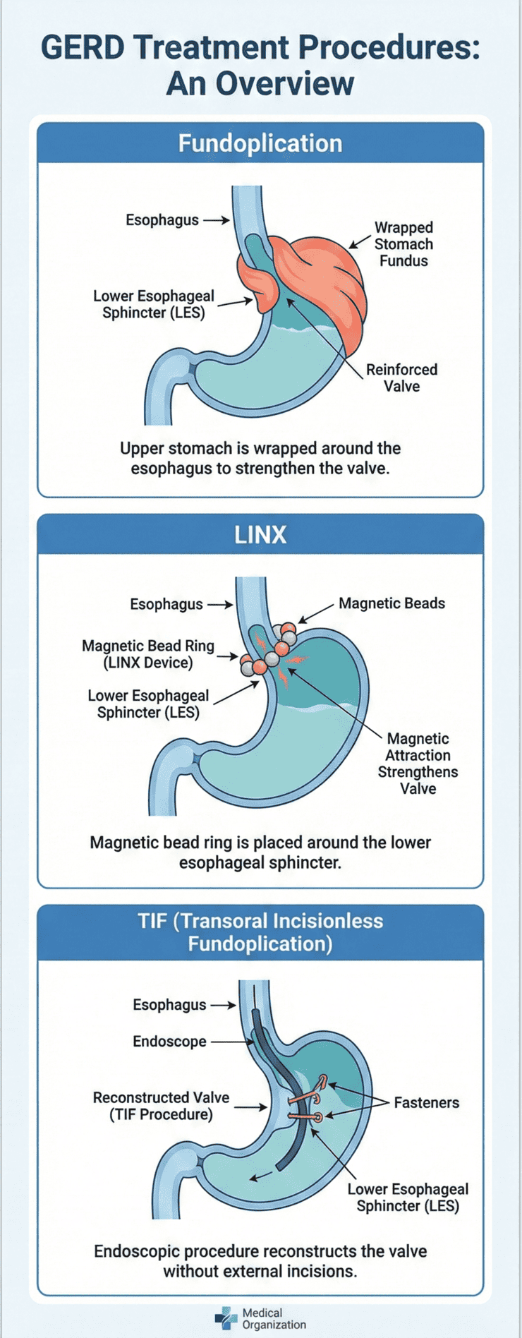 Diagram comparing three GERD treatment procedures fundoplication, LINX, and TIF