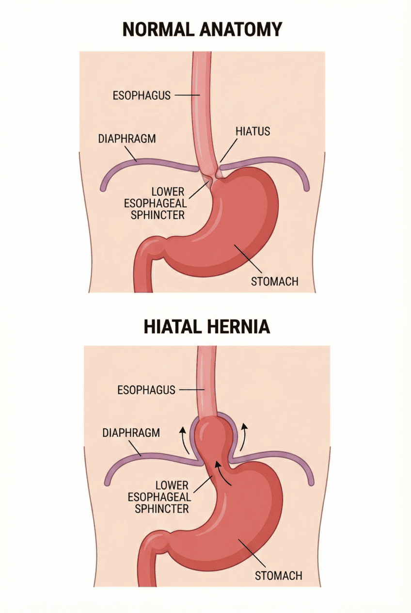 Diagram of hiatal hernia Diagram of hiatal hernia