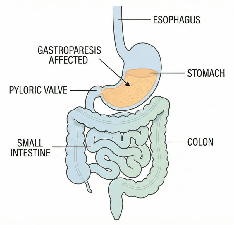Diagram of stomach and digestive system showing gastroparesis