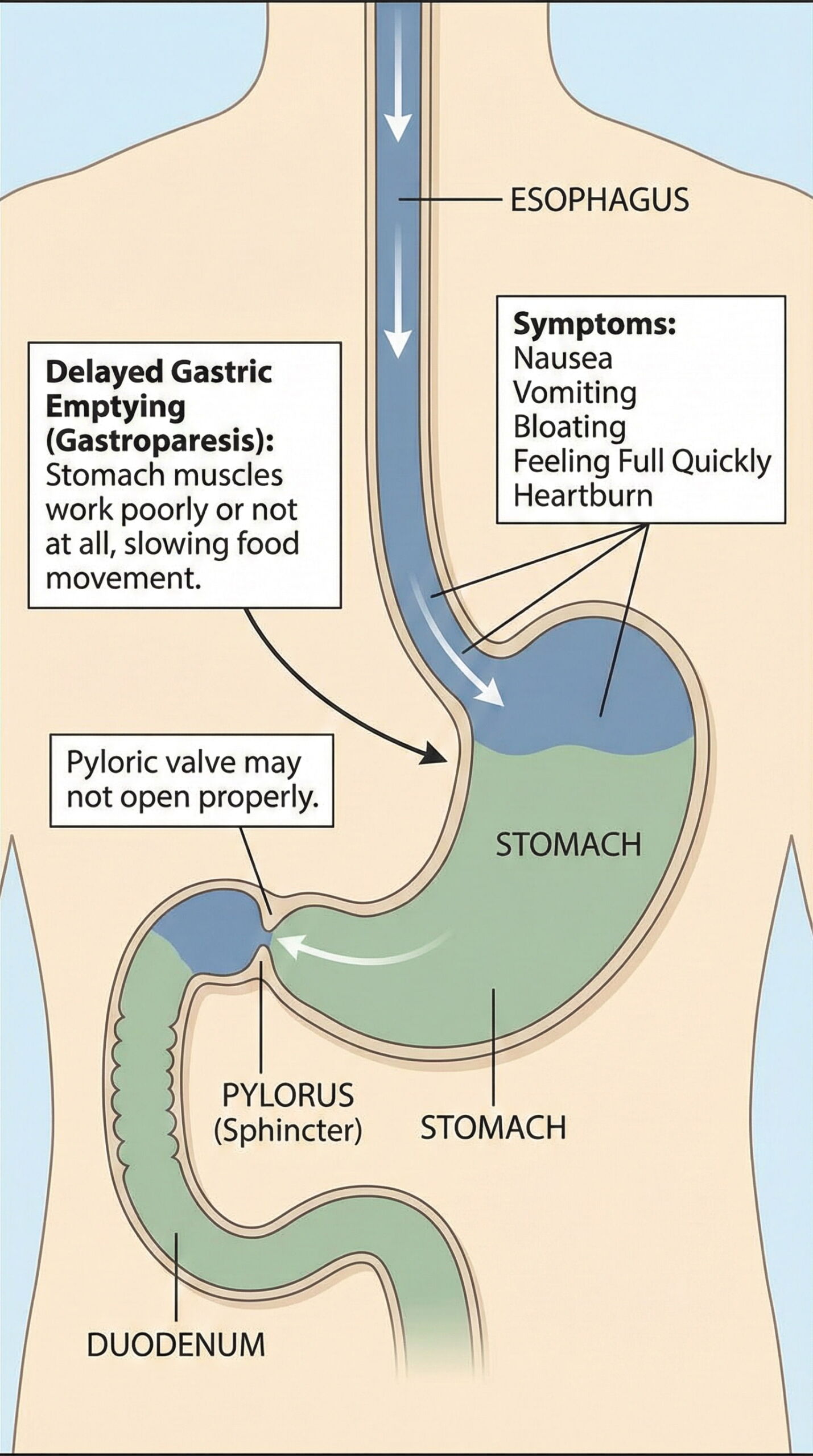 Diagram showing causes and symptoms of delayed gastric emptying.