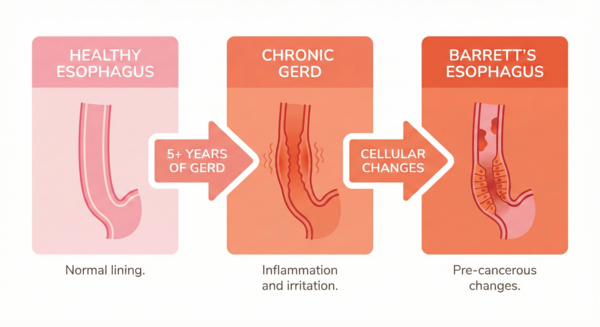 Simple GERD to Barrett's esophagus progression