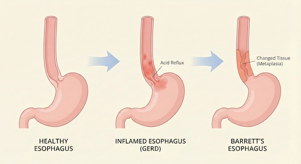 Progression from chronic heartburn to Barrett's esophagus