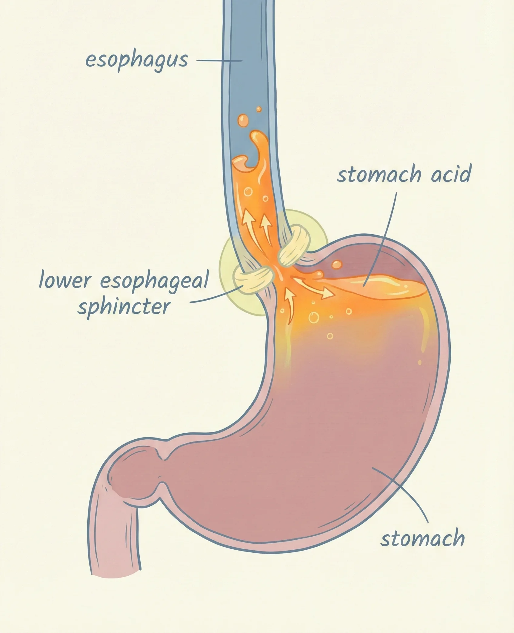 Acid reflux diagram showing stomach and esophageal valve Acid reflux diagram showing stomach and esophageal valve
