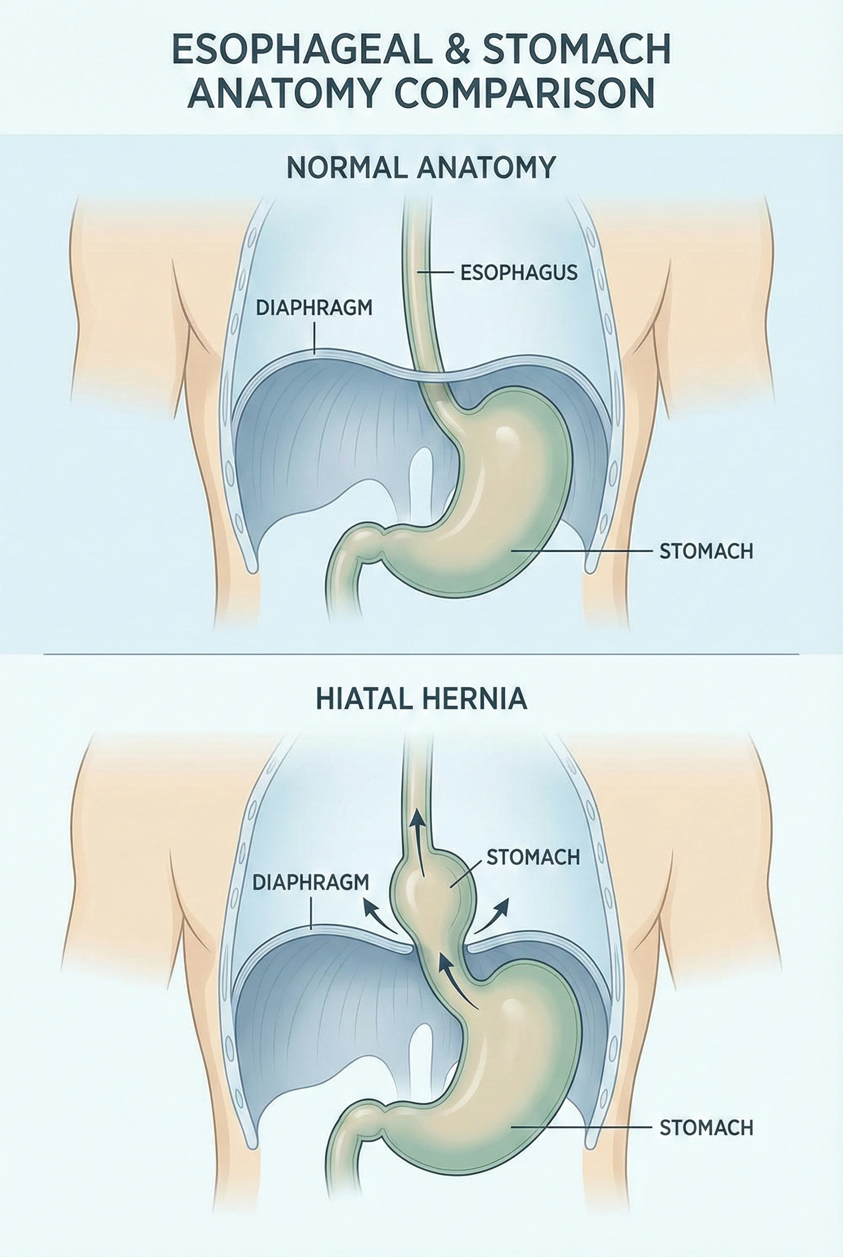 Diagram comparing normal anatomy and hiatal hernia with stomach displaced into chest