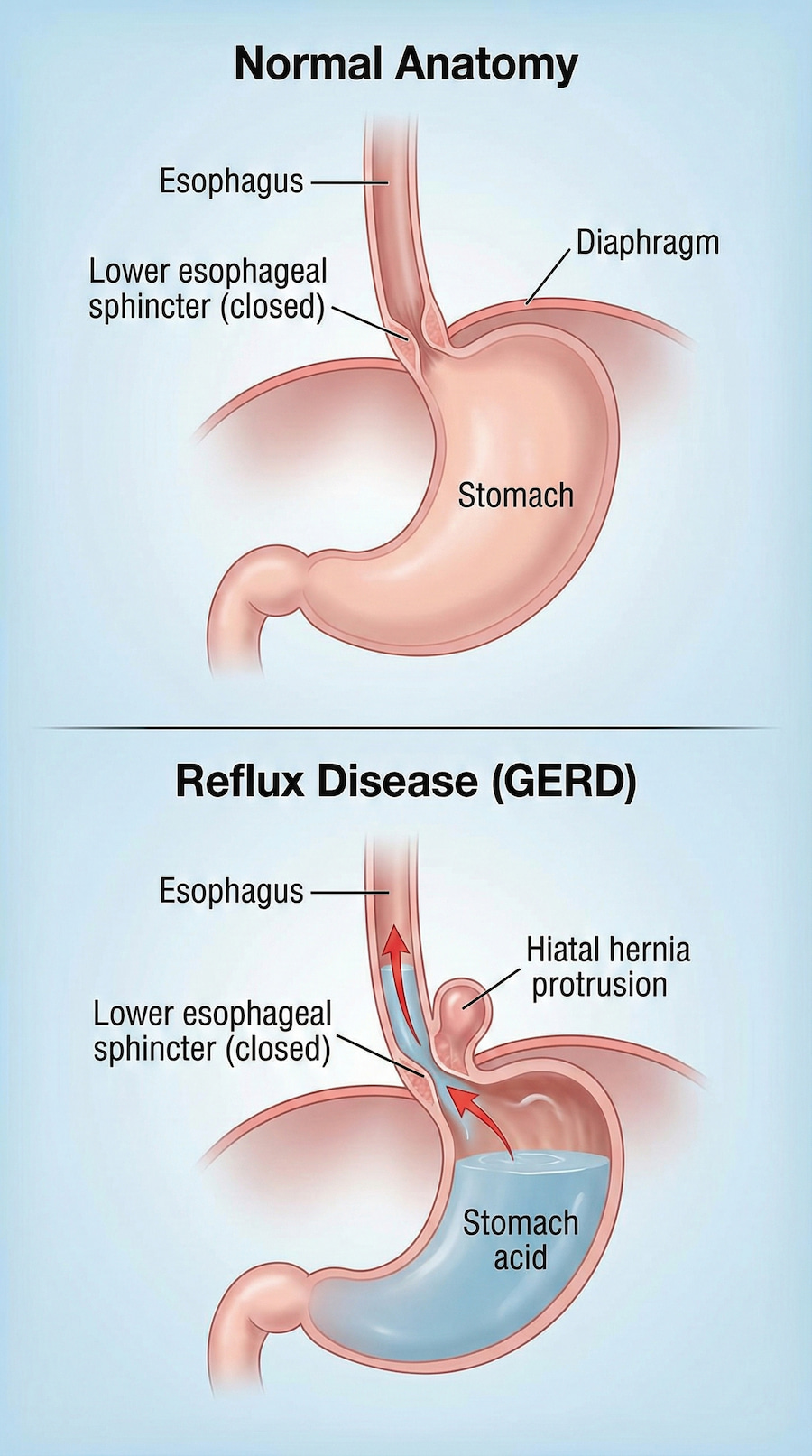 Medical illustration difference between normal anatomy and reflux disease Medical illustration difference between normal anatomy and reflux disease