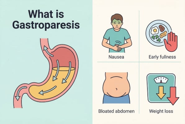 What is gastroparesis and common symptoms