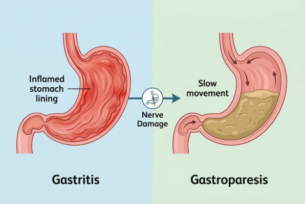 How gastritis can lead to gastroparesis
