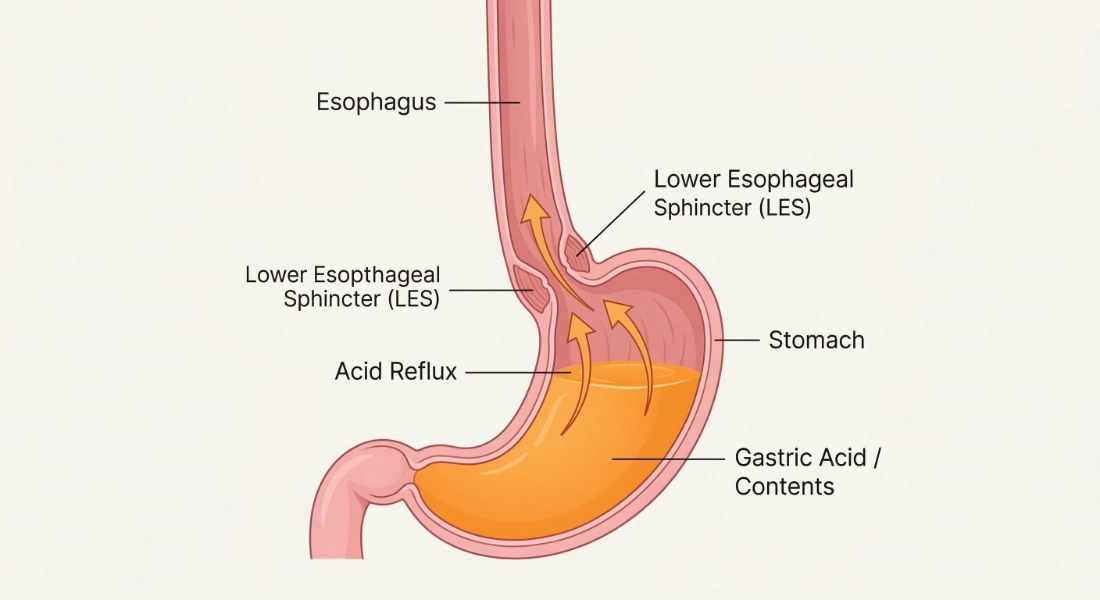 Acid reflux diagram showing stomach contents rising into the esophagus.