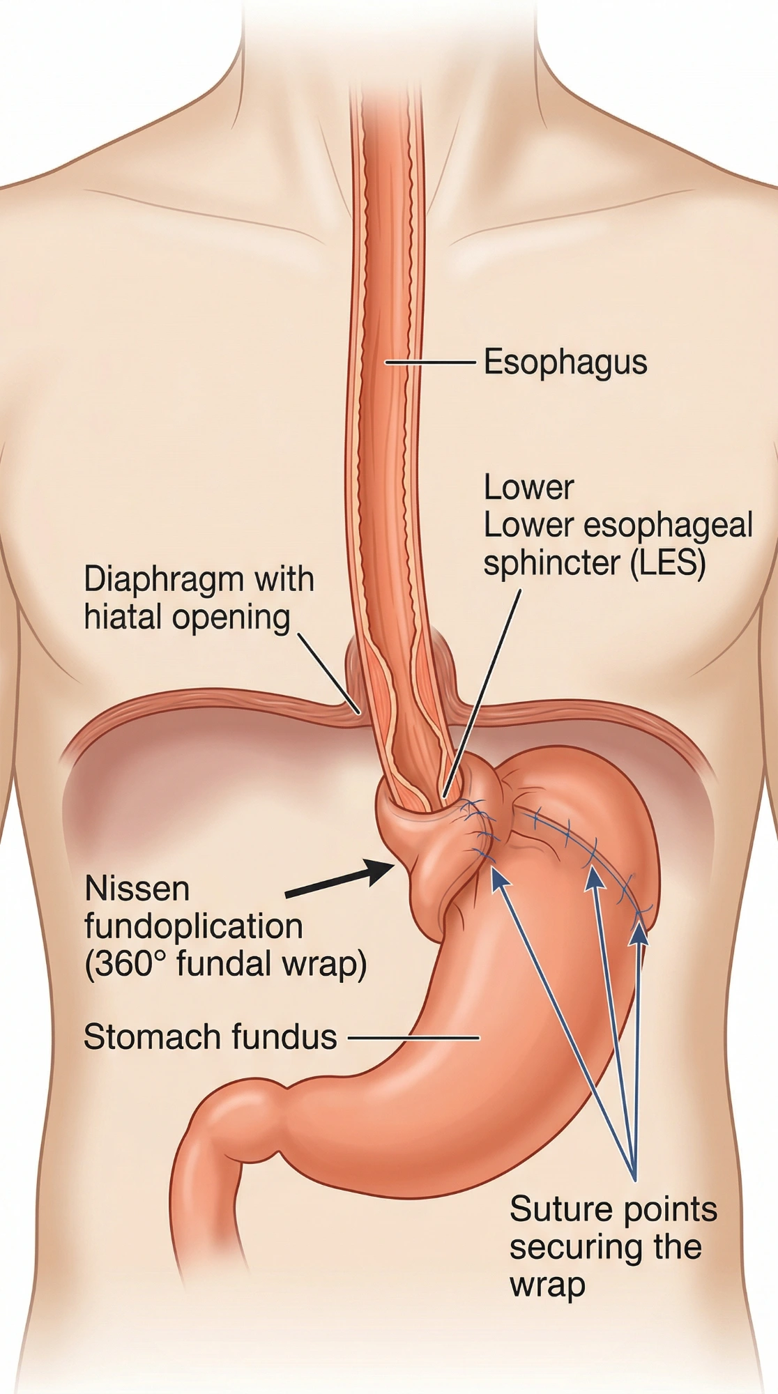 Diagram of Nissen fundoplication surgery with the stomach wrapped around the lower esophagus to prevent acid reflux Diagram of Nissen fundoplication surgery with the stomach wrapped around the lower esophagus to prevent acid reflux