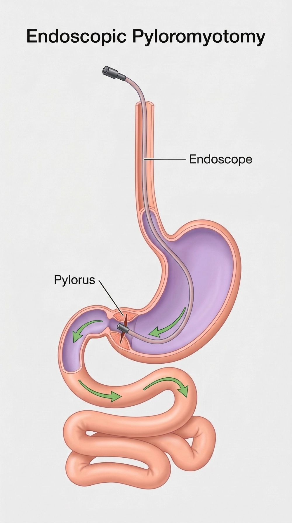 Endoscope treating the pylorus valve to improve digestion flow.