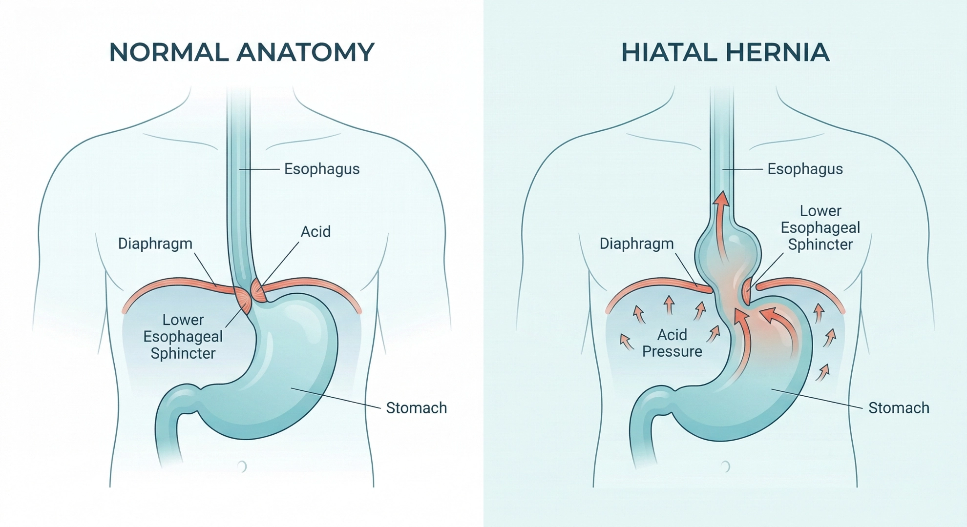 Normal anatomy vs hiatal hernia diagram