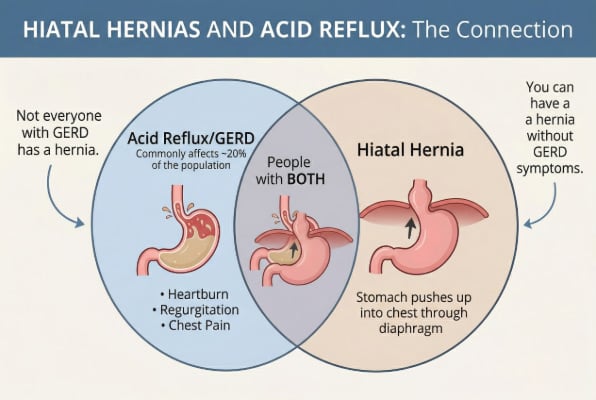 Connection between hiatal hernias and acid reflux