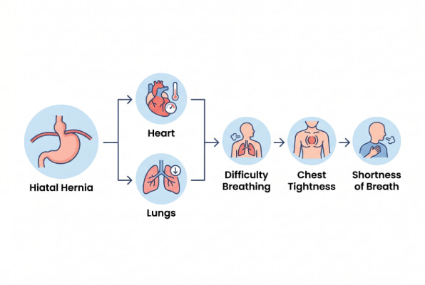 How hiatal hernia affects heart and lungs