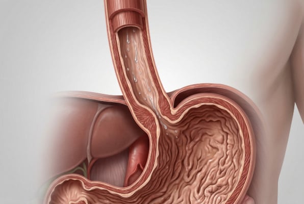 Cross-section of esophagus and stomach showing how saliva helps clear acid in reflux patients