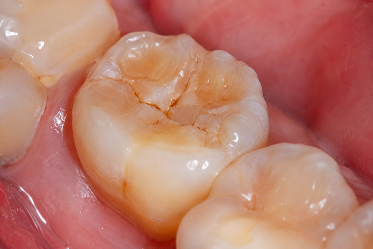 Close-up of a lower molar with enamel erosion from acid reflux affecting the teeth