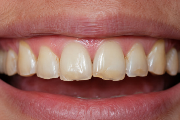 Worn translucent front teeth showing signs of acid reflux tooth erosion